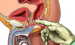 自己按摩前列腺十种手法图解