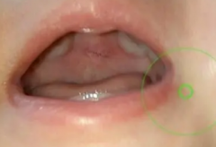 嘴上颚有包是什么原因