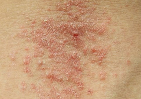 过敏与湿疹的区别图片(图1)