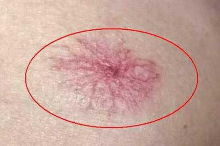 肝不好身上有红点图片(图1)