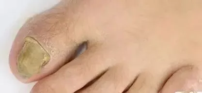 灰指甲最怕三个克星(图1)