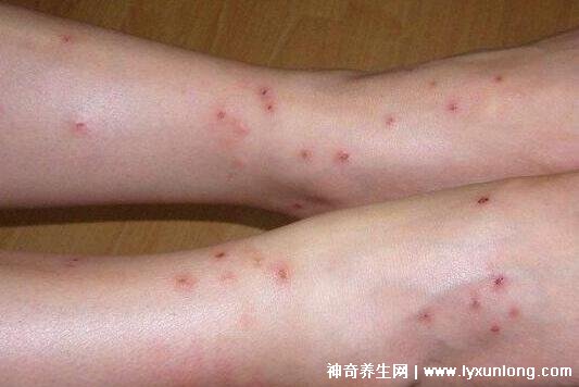 跳蚤咬过后的疙瘩照片红肿剧痒的疙瘩中央有伤口附处理法