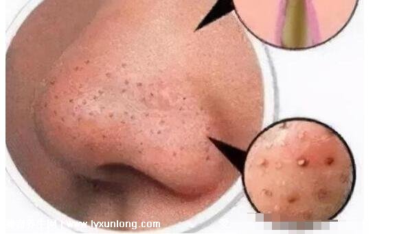 闭口粉刺真正的图片，粗糙的颗粒会发炎长脓疱(黑头也是粉刺)
