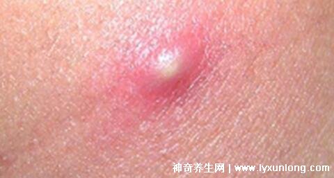 毛囊炎的症状和图片，针头大的红疹长成脓疱中央有毛发贯穿