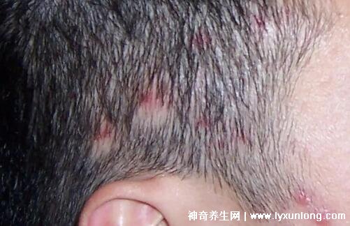 毛囊炎的症状和图片，针头大的红疹长成脓疱中央有毛发贯穿