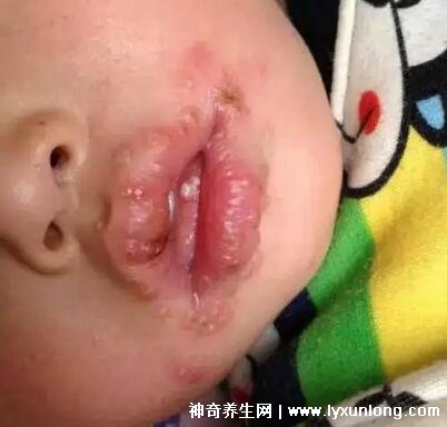 孩子口腔疱疹图片