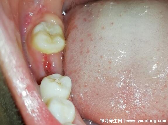 拔牙15天后牙窝状态图图片