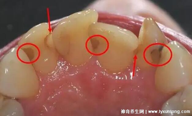 牙结石严重程度示意图图片