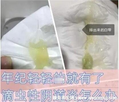 滴虫性阴炎排泄物图片黄绿色泡沫状白带很酸臭附霉菌症状